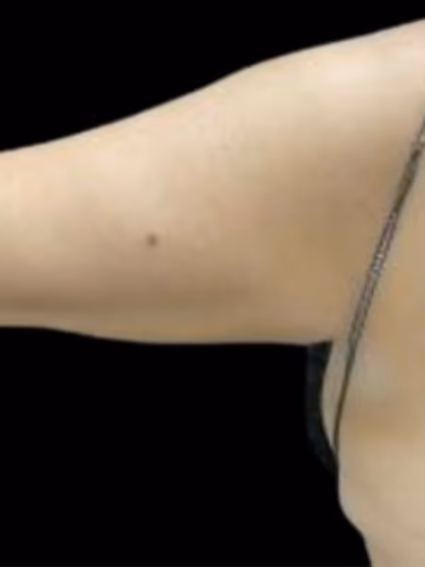 JOHANNA_BODYCONTOURING_COOLSCULPTING_ARMS