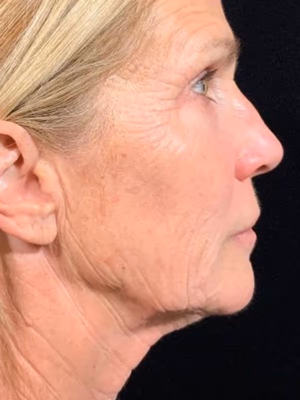 KELLY MORGAN_SCULPTRA