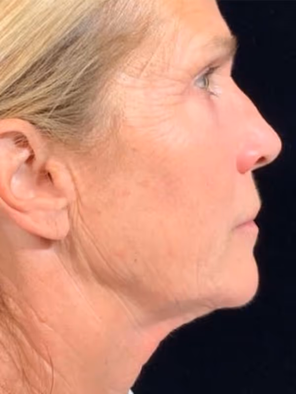 KELLY MORGAN_SCULPTRA