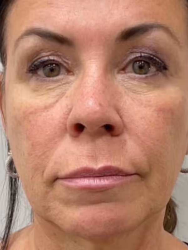 JOCELYN_LIQUIDFACELIFT