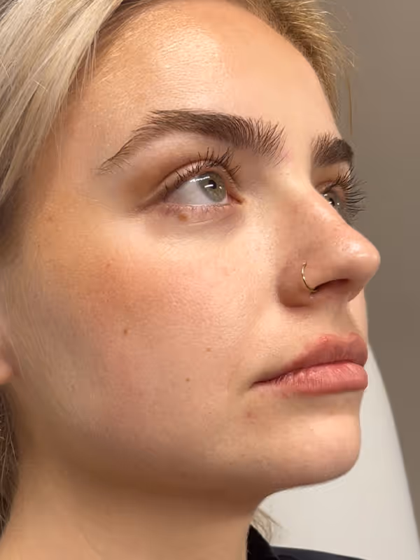 JAMIE_CHIN FILLER_PREJOWLSULCUS