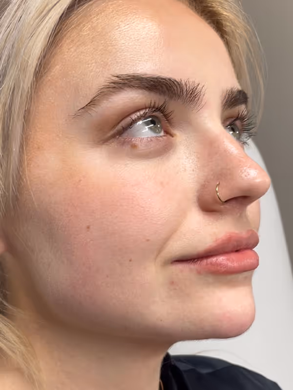 JAMIE_CHIN FILLER_PREJOWLSULCUS