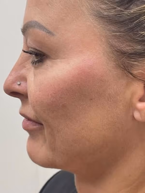 JOCELYN_CHEEK_CHIN_FILLER