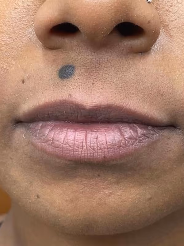 JOCELYN_LIPFILLER_ULTRA
