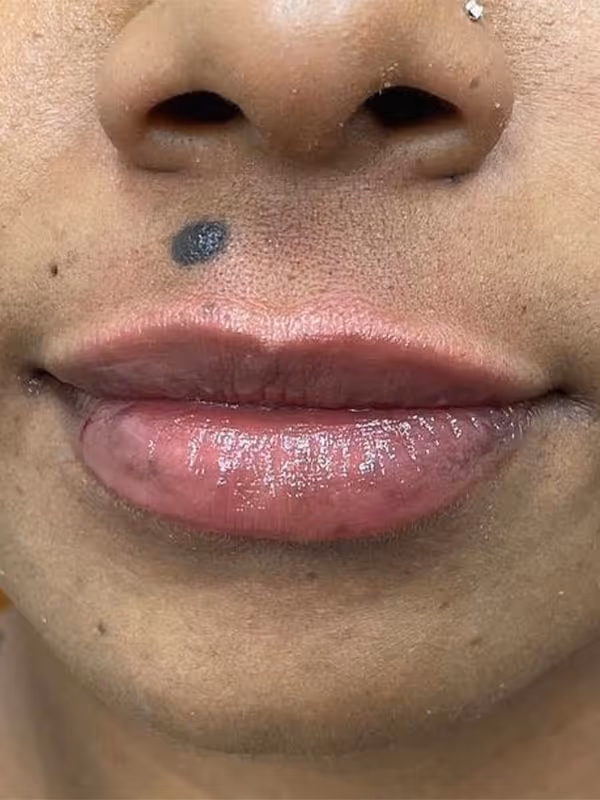 JOCELYN_LIPFILLER_ULTRA