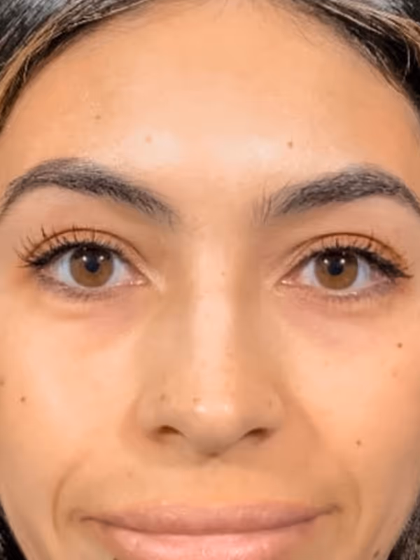 SIERRA_TEARTROUGHS_RESTYLANE