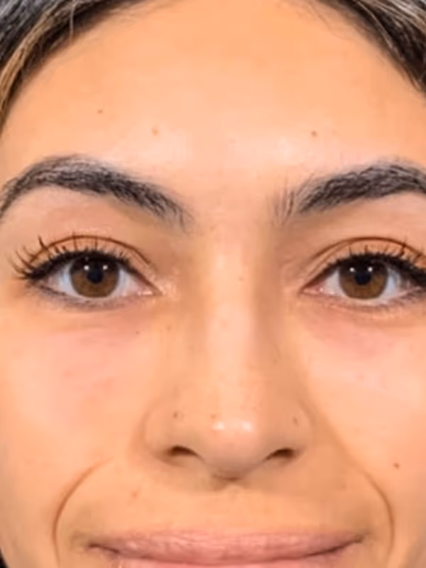 SIERRA_TEARTROUGHS_RESTYLANE