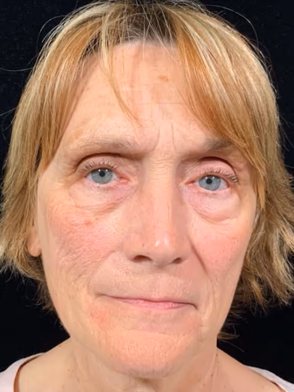 JAMIE_LIQUID_FACELIFT