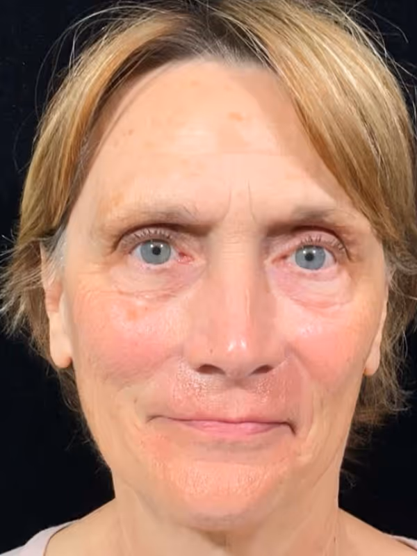 JAMIE_LIQUID_FACELIFT