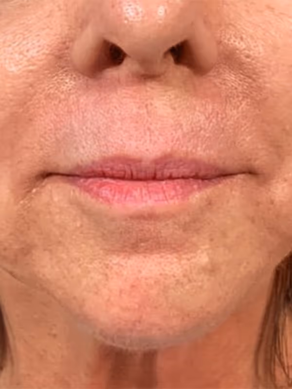 DANIKA_LOWERFACEFILLER_MARIONETTES_NLF