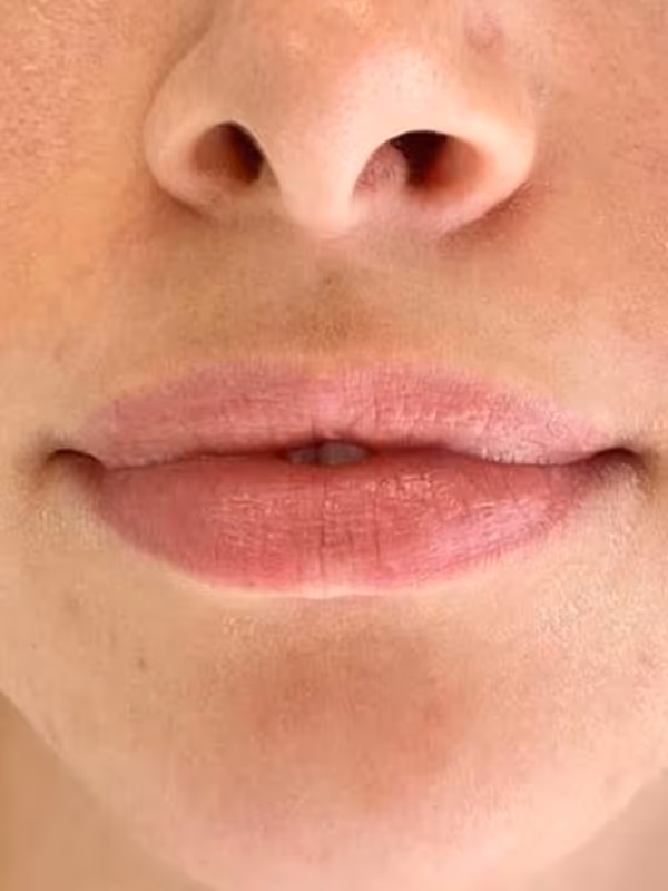 DANIKA_LIPFILLER_REFYNE