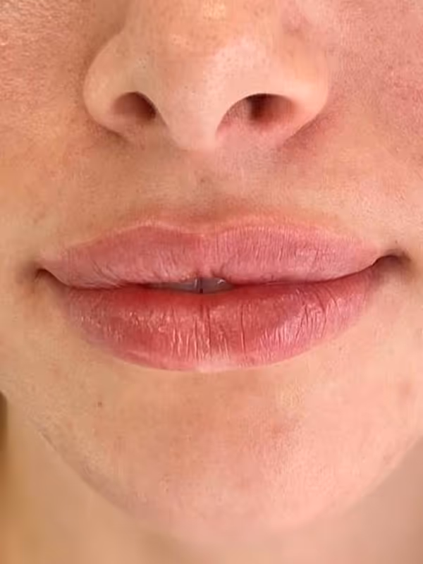 DANIKA_LIPFILLER_REFYNE