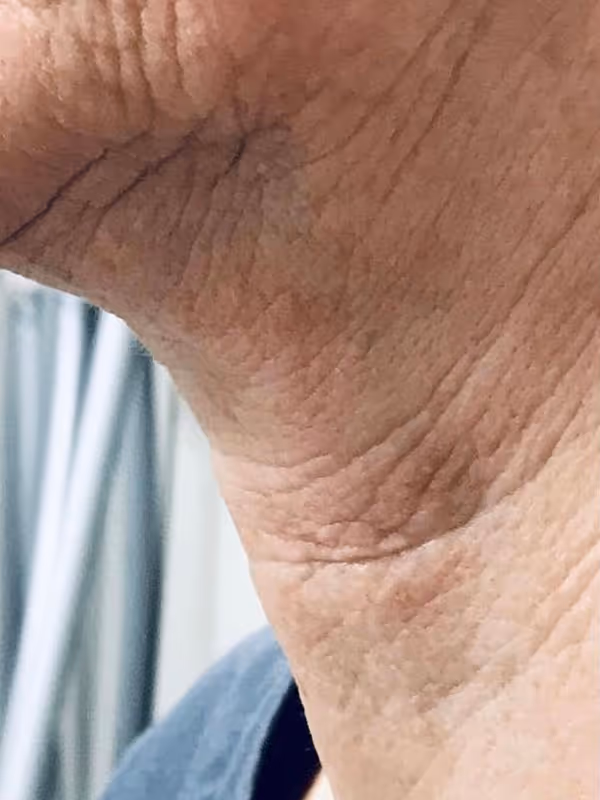 MELISSA_BOTOX_NECKNBANDS