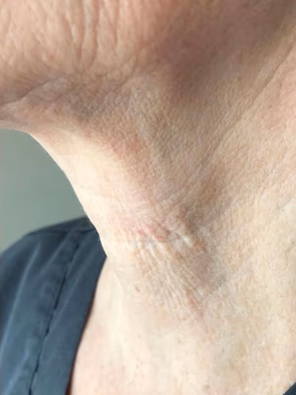 MELISSA_BOTOX_NECKNBANDS