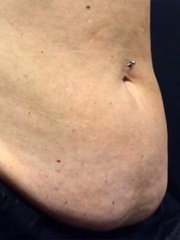 KATIE_COOLSCULPTING_ABDOMEN