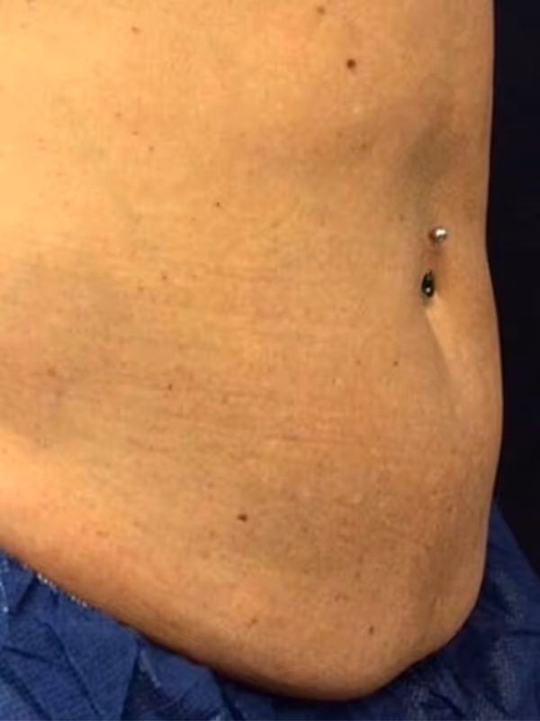 KATIE_COOLSCULPTING_ABDOMEN