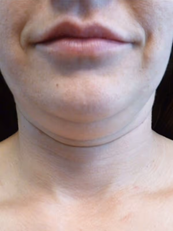 KATIE_COOLSCULPTING_CHIN
