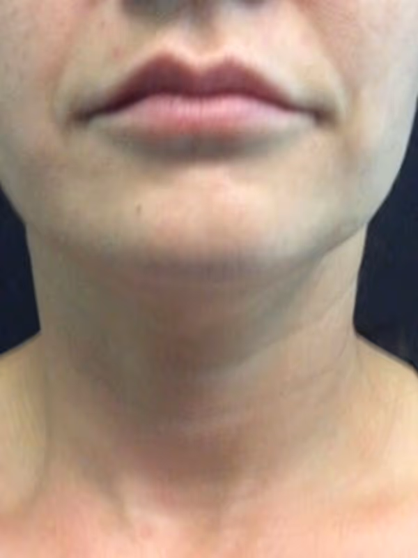 KATIE_COOLSCULPTING_CHIN