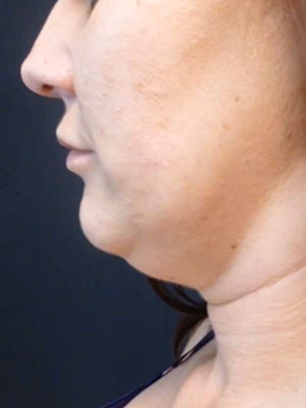 KATIE_COOLSCULPTING_CHIN