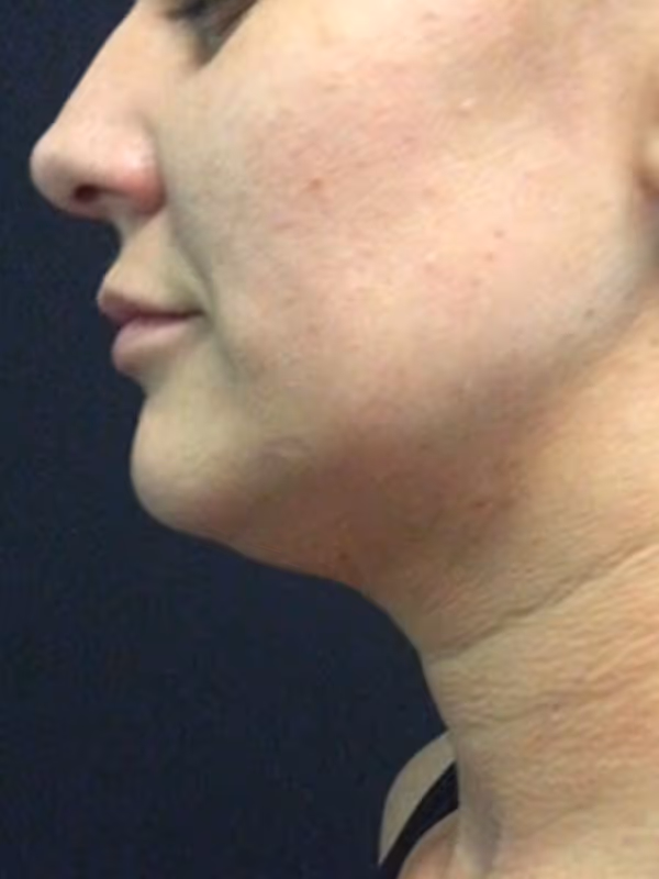 KATIE_COOLSCULPTING_CHIN