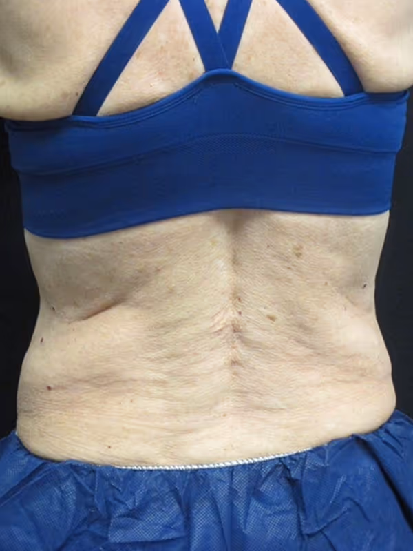 KATIE_COOLSCULPTING_BACKFAT