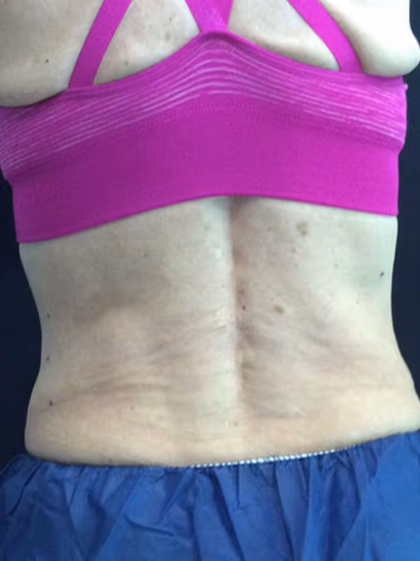 KATIE_COOLSCULPTING_BACKFAT