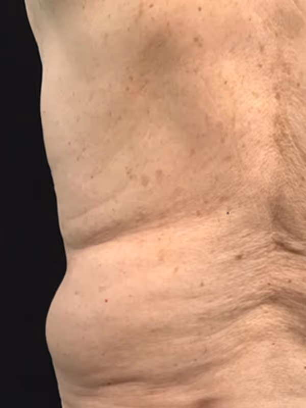 KATIE_COOLSCULPTING_BACK