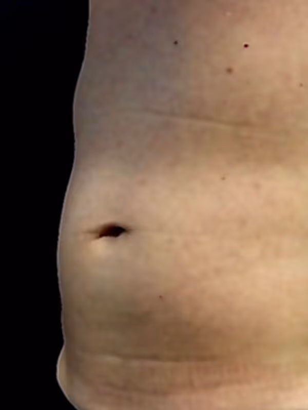 KATIE_COOLSCULPTING_STOMACH