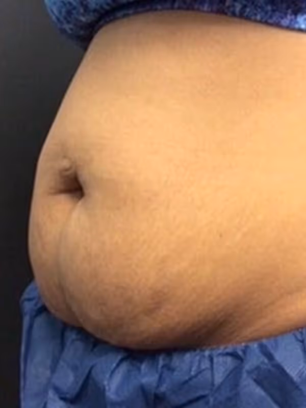 KATIE_COOLSCULPTING_STOMACH