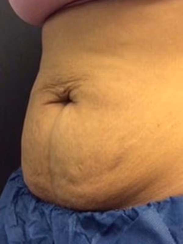 KATIE_COOLSCULPTING_STOMACH