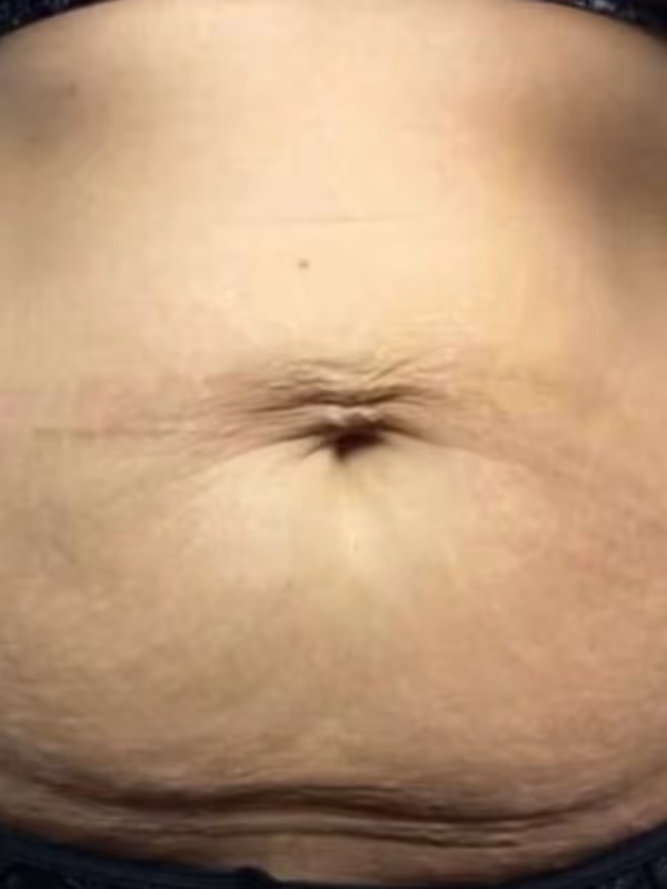KATIE_COOLSCULPTING_STOMACH