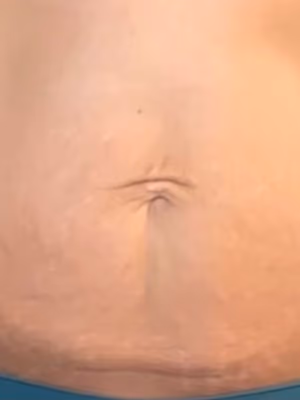 KATIE_COOLSCULPTING_STOMACH