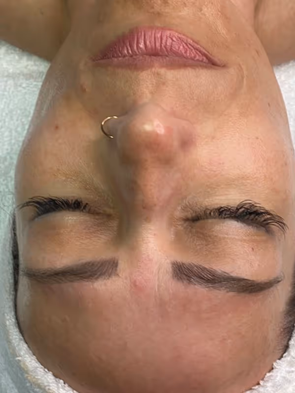 CAMILLE_HYDRAFACIAL