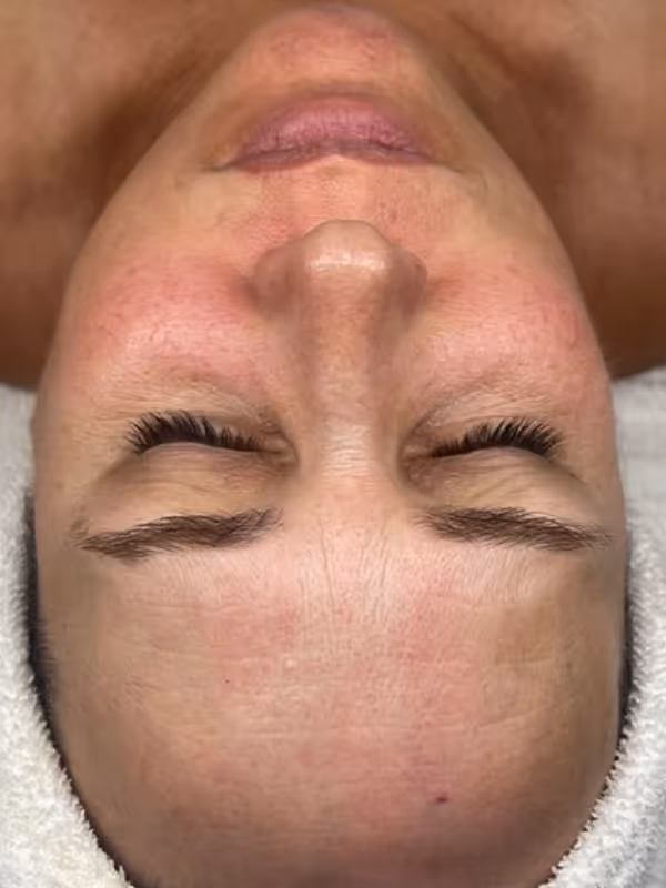 ALLIE_HYDRAFACIAL