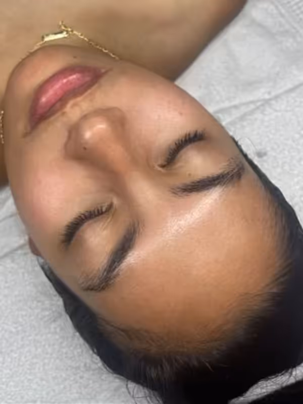 ALLIE_HYDRAFACIAL