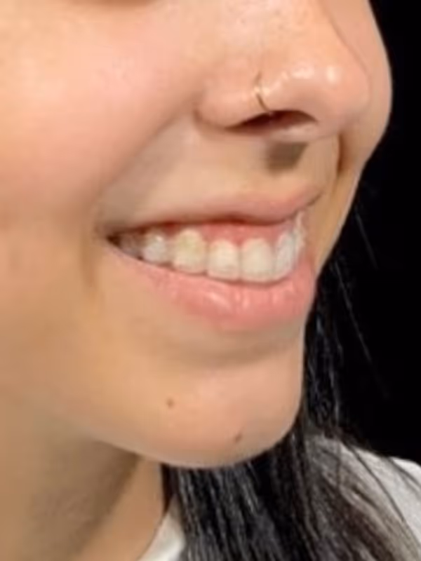 BRENNA_LIPFILLER_GUMMYSMILE