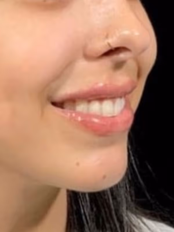 BRENNA_LIPFILLER_GUMMYSMILE