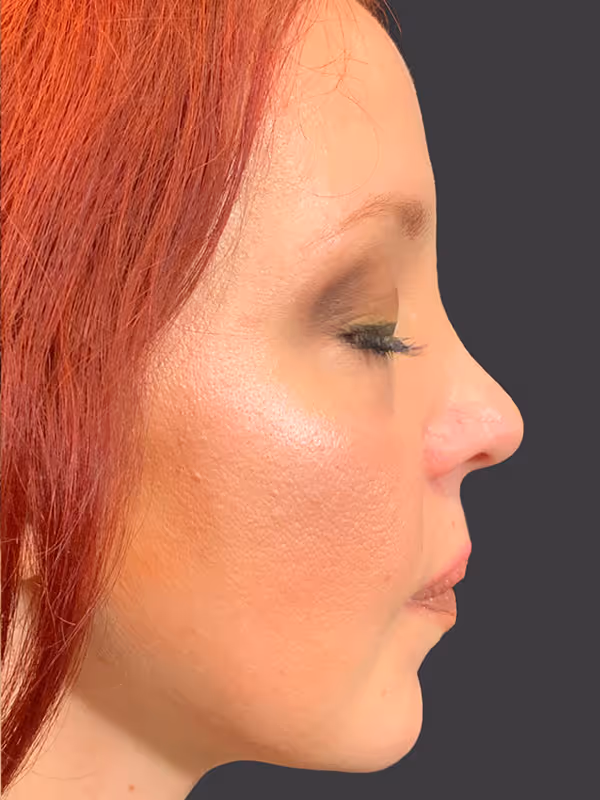 Rhinoplasty4