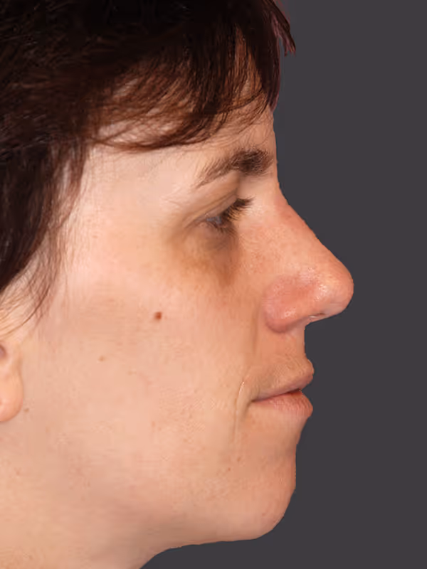 Rhinoplasty5
