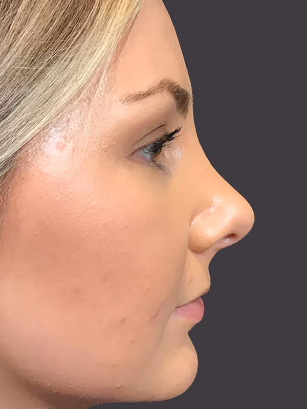 Rhinoplasty13
