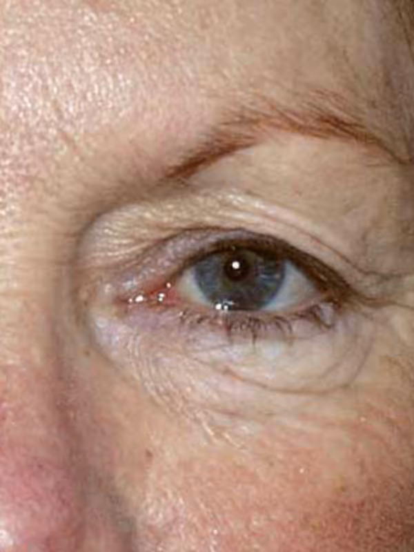 Eyelid Lift1