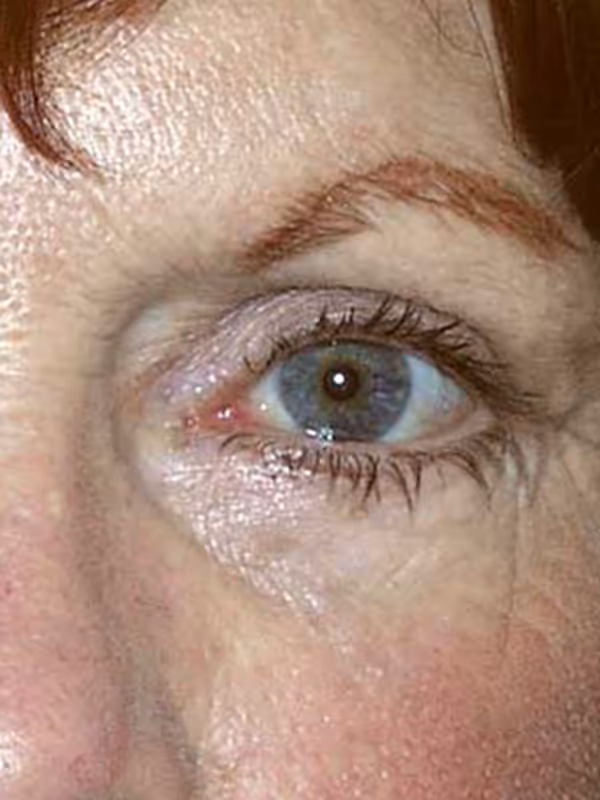 Eyelid Lift1