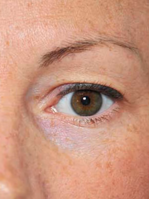 Eyelidlift4