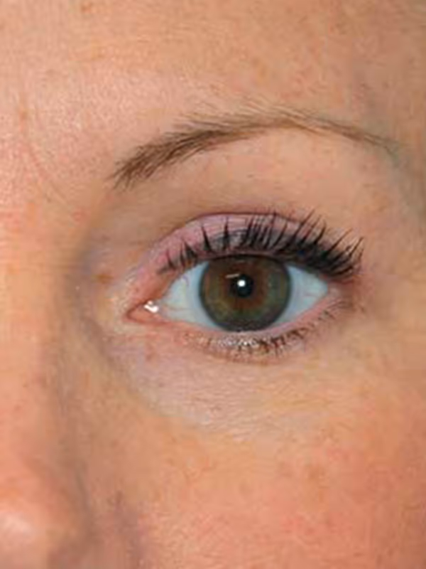 Eyelidlift4