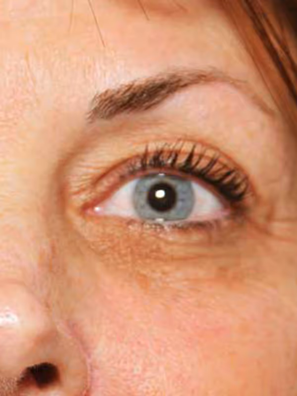 Eyelidlift5
