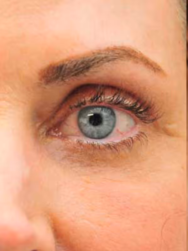 Eyelidlift5