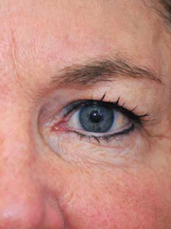 Eyelidlift7