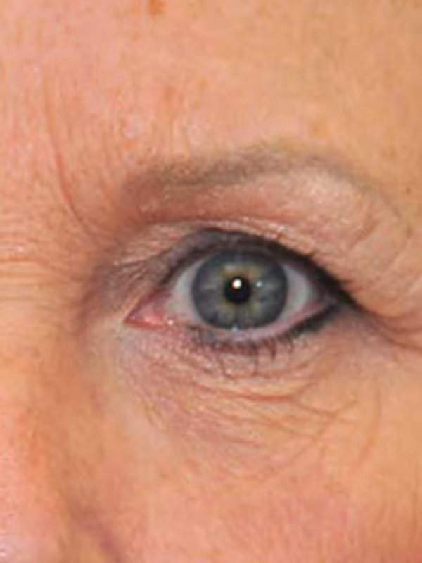 Eyelidlift8