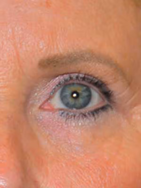 Eyelidlift8