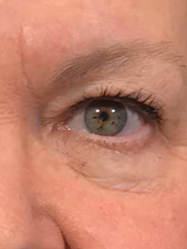 Eyelidlift9